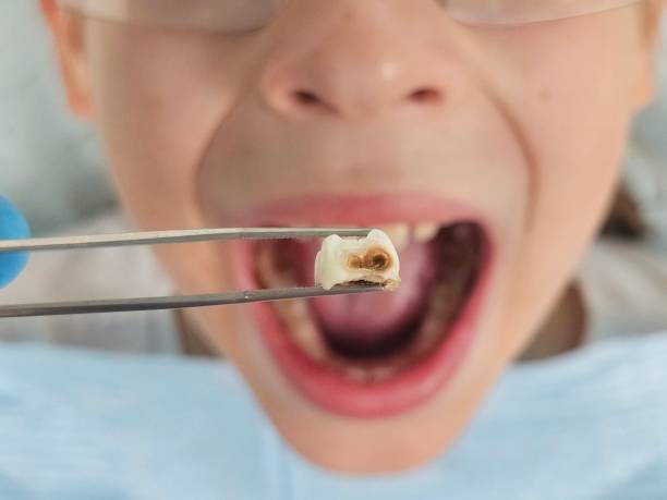 Best Emergency Root Canal Treatment in Cold Spring, MN